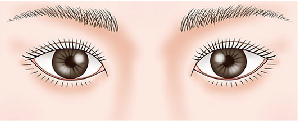 蒙古襞修正 傷の修正イメージ